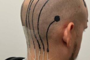 Revolutionary E-Tattoos Printing Brain Monitoring Electronics Directly on the Scalp